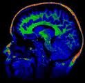 image IRM du cerveau